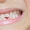 歯はなぜ生え変わるんですか？